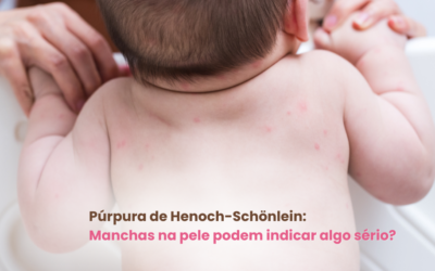 Púrpura de Henoch-Schönlein: Manchas na pele podem indicar algo sério?